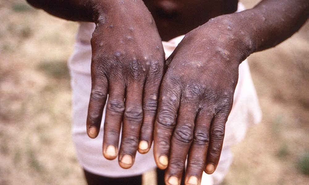 Monkeypox in Uganda