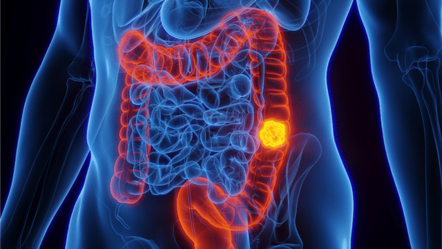 colorectal cancer